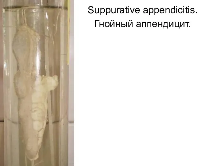 Suppurative appendicitis. Гнойный аппендицит.