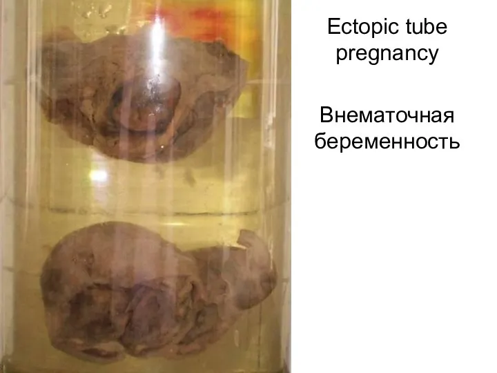 Ectopic tube pregnancy Внематочная беременность