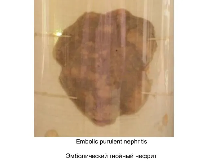 Embolic purulent nephritis Эмболический гнойный нефрит