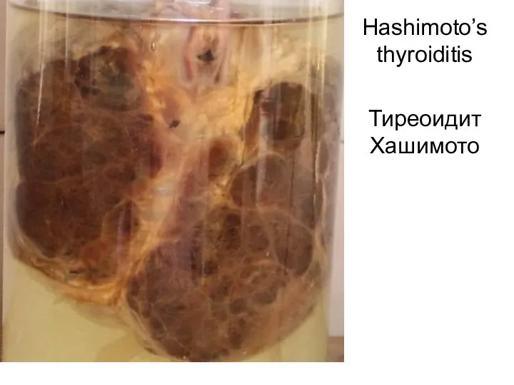Hashimoto’s thyroiditis Тиреоидит Хашимото