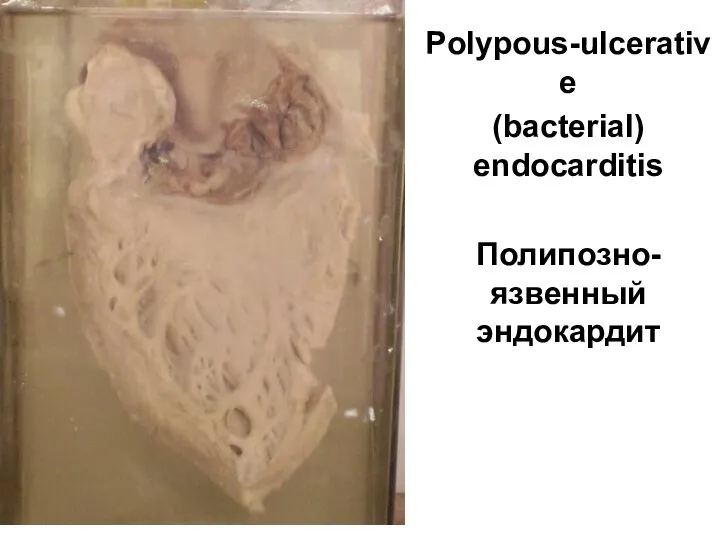 Polypous-ulcerative (bacterial) endocarditis Полипозно-язвенный эндокардит
