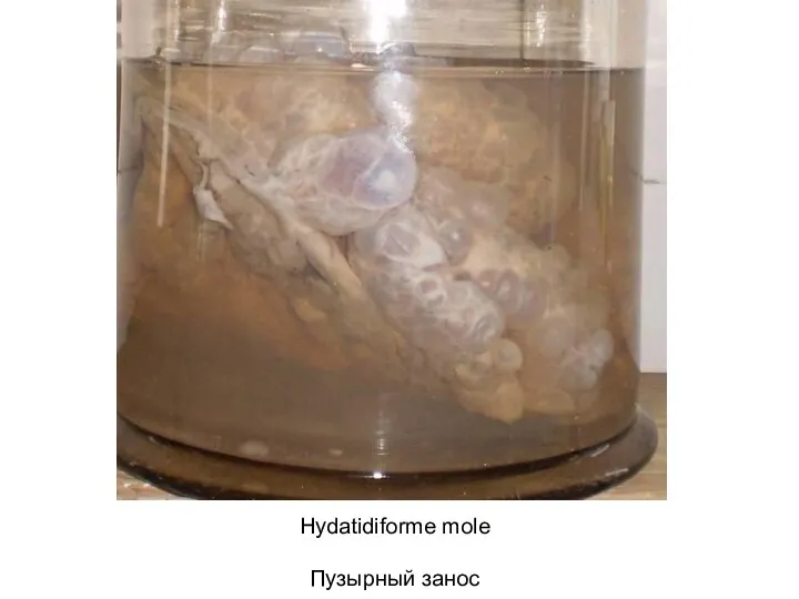 Hydatidiforme mole Пузырный занос