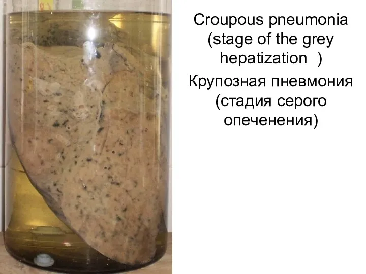 Croupous pneumonia (stage of the grey hepatization ) Крупозная пневмония (стадия серого опеченения)