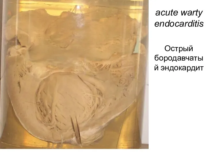 acute warty endocarditis Острый бородавчатый эндокардит