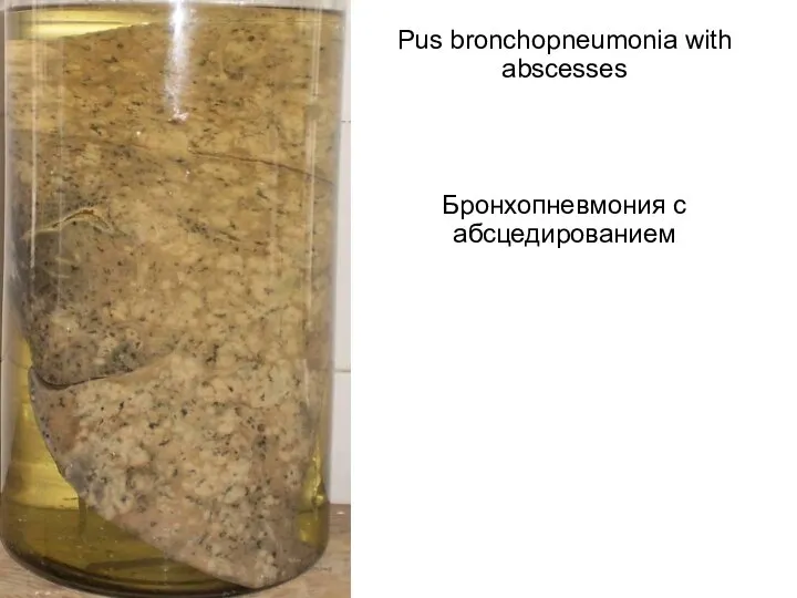 Pus bronchopneumonia with abscesses Бронхопневмония с абсцедированием