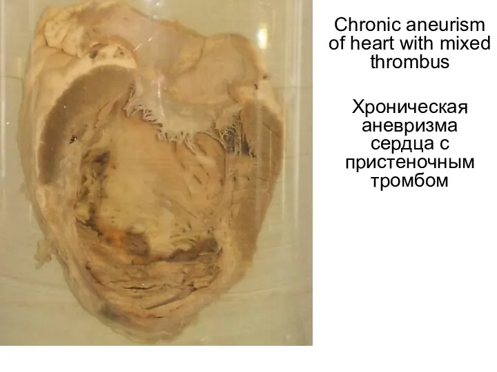 Chronic aneurism of heart with mixed thrombus Хроническая аневризма сердца с пристеночным тромбом