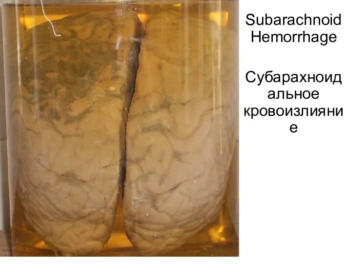 Subarachnoid Hemorrhage Субарахноидальное кровоизлияние