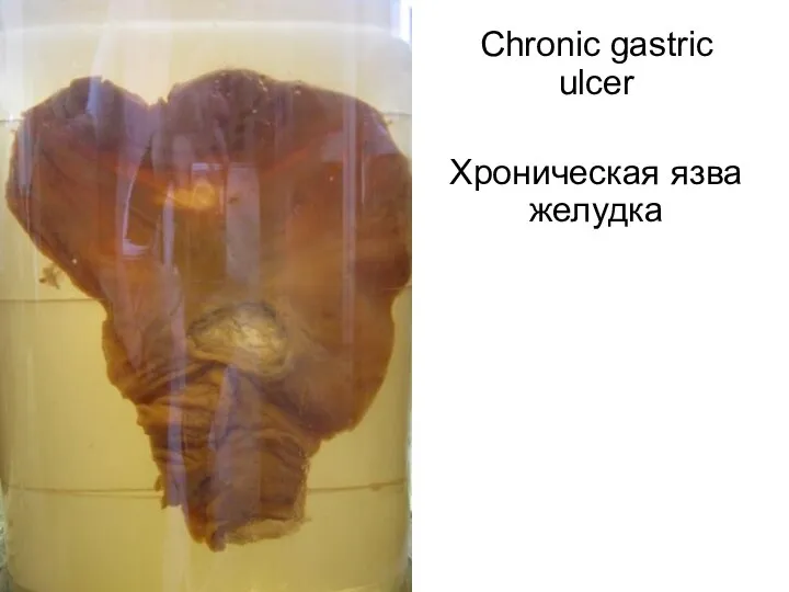 Chronic gastric ulcer Хроническая язва желудка