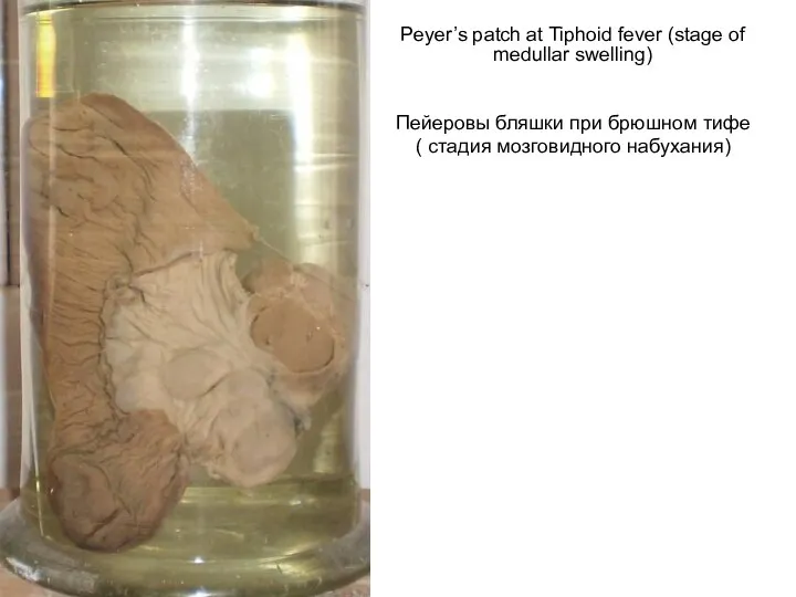 Peyer’s patch at Tiphoid fever (stage of medullar swelling) Пейеровы бляшки