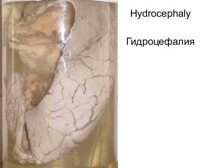 Hydrocephaly Гидроцефалия
