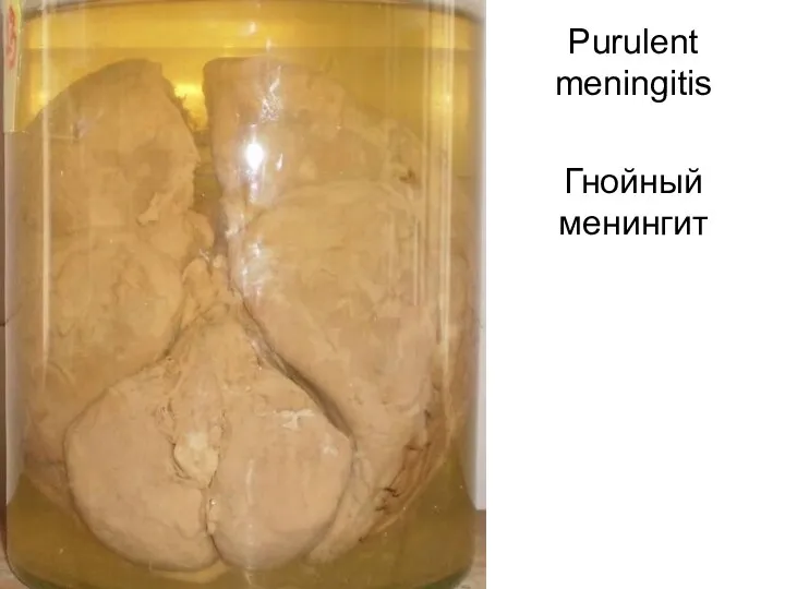 Purulent meningitis Гнойный менингит