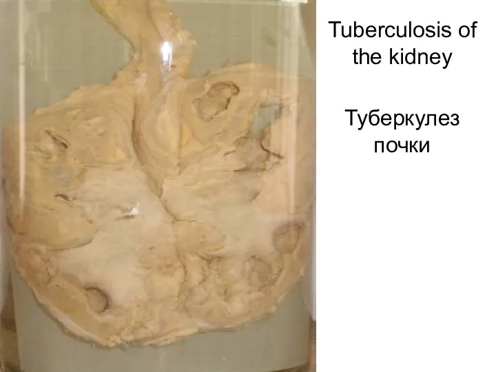 Tuberculosis of the kidney Туберкулез почки