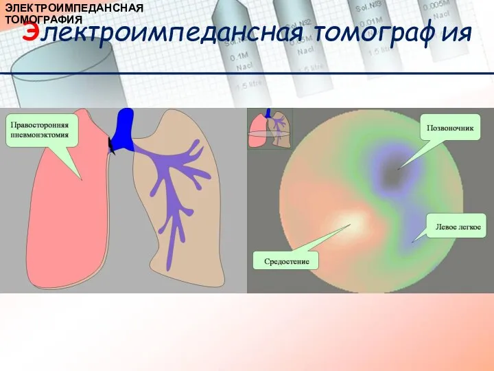 Электроимпедансная томография ЭЛЕКТРОИМПЕДАНСНАЯ ТОМОГРАФИЯ