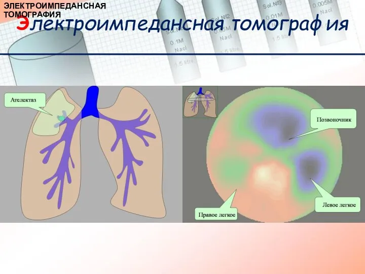 Электроимпедансная томография ЭЛЕКТРОИМПЕДАНСНАЯ ТОМОГРАФИЯ