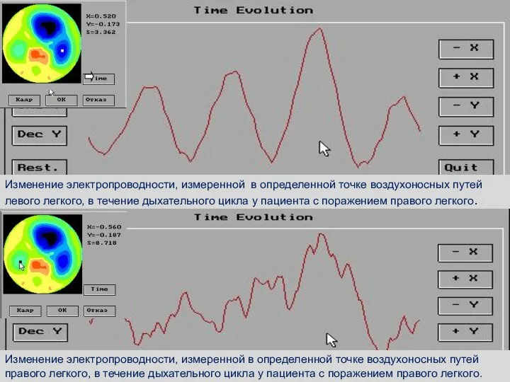 Изменение электропроводности, измеренной в определенной точке воздухоносных путей левого легкого, в