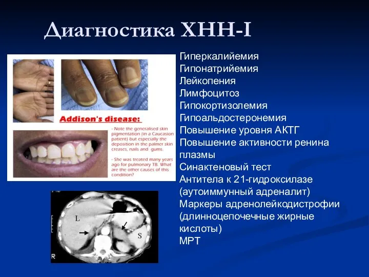 Диагностика ХНН-I Гиперкалийемия Гипонатрийемия Лейкопения Лимфоцитоз Гипокортизолемия Гипоальдостеронемия Повышение уровня АКТГ