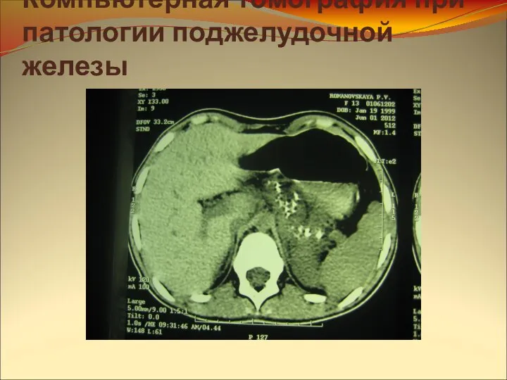 Компьютерная томография при патологии поджелудочной железы