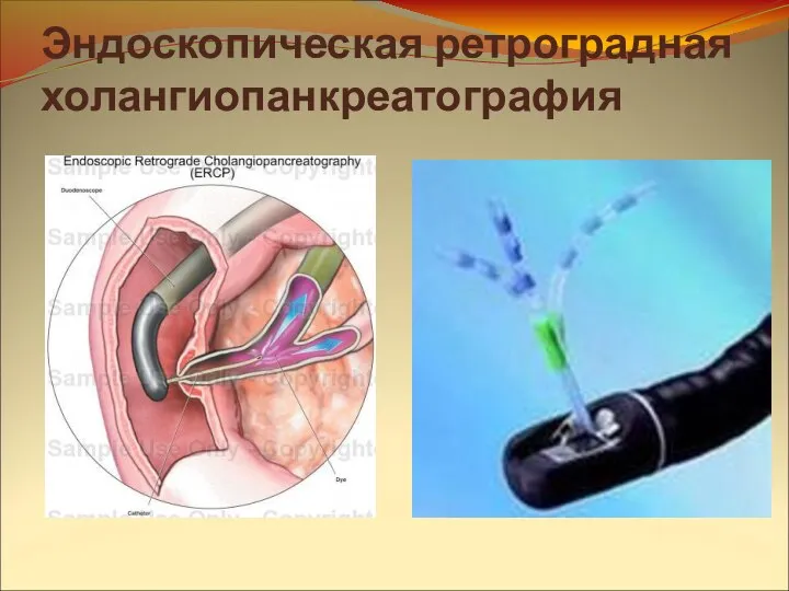 Эндоскопическая ретроградная холангиопанкреатография