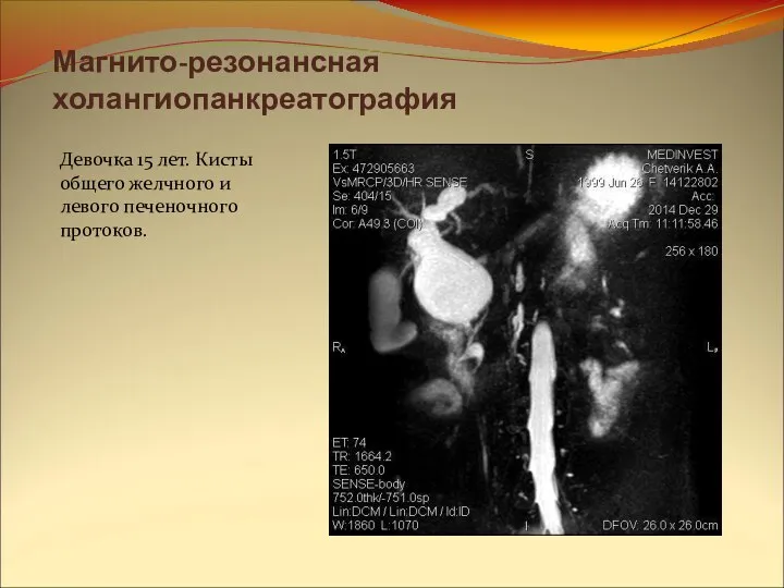 Магнито-резонансная холангиопанкреатография Девочка 15 лет. Кисты общего желчного и левого печеночного протоков.