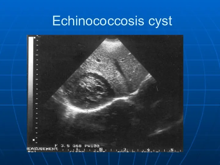 Echinococcosis cyst