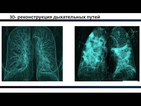 3D- реконструкция дыхательных путей