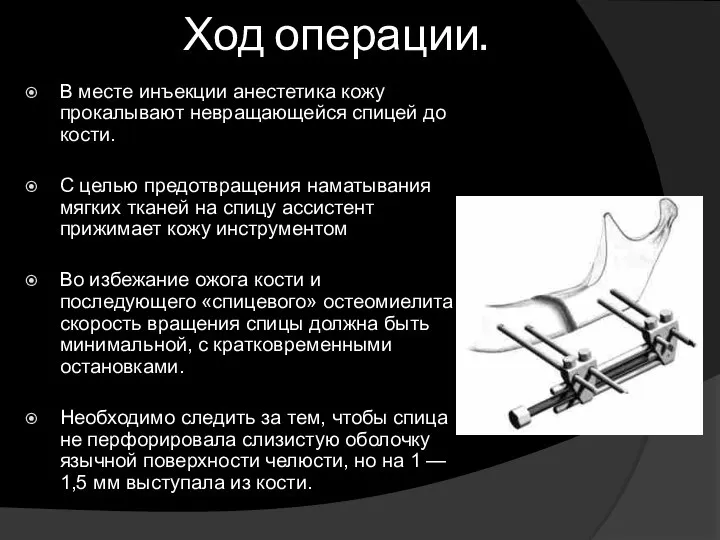 Ход операции. В месте инъекции анестетика кожу прокалывают невращающейся спицей до