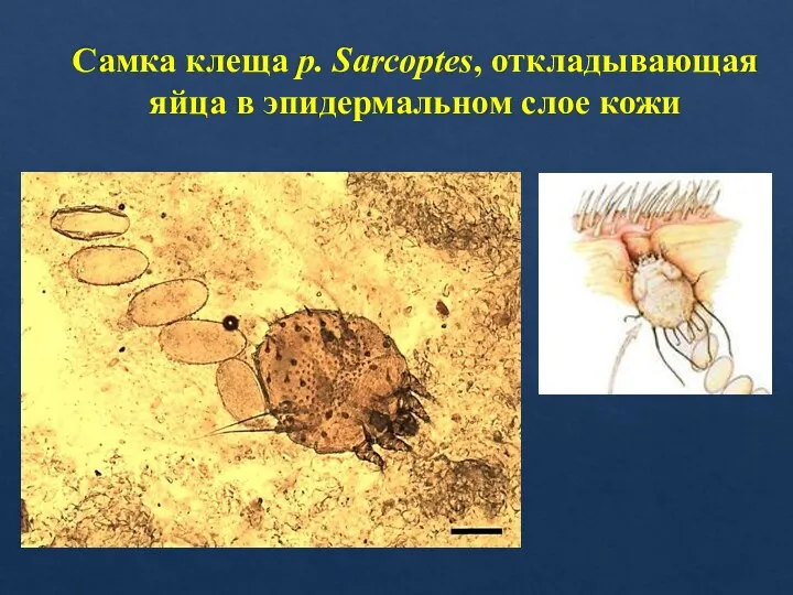 Самка клеща р. Sarcoptes, откладывающая яйца в эпидермальном слое кожи