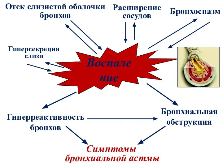 Воспаление Гиперреактивность бронхов Бронхиальная обструкция Симптомы бронхиальной астмы Отек слизистой оболочки