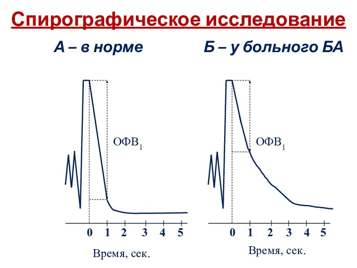 Спирографическое исследование А – в норме Б – у больного БА