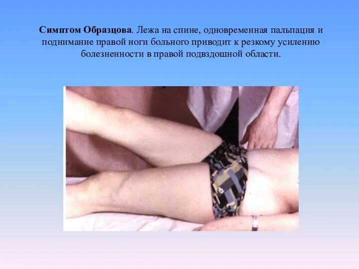 Симптом Образцова. Лежа на спине, одновременная пальпация и поднимание правой ноги