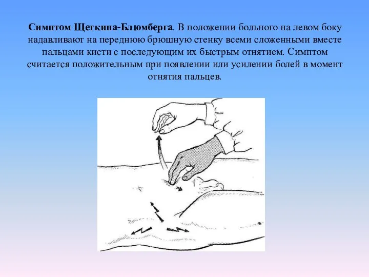 Симптом Щеткина-Блюмберга. В положении больного на левом боку надавливают на переднюю