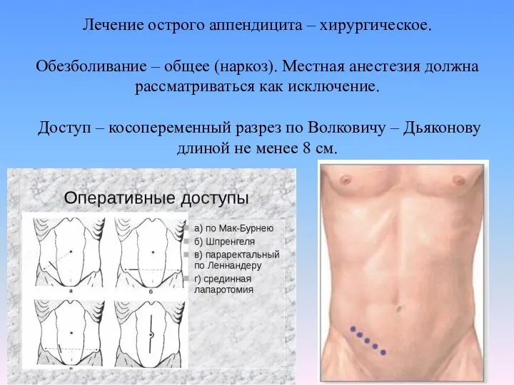 Лечение острого аппендицита – хирургическое. Обезболивание – общее (наркоз). Местная анестезия