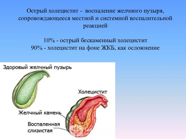 Острый холецистит - воспаление желчного пузыря, сопровождающееся местной и системной воспалительной