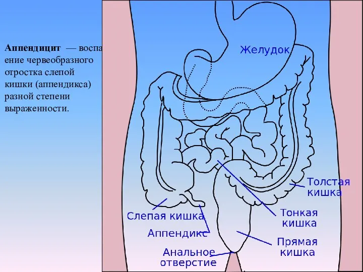 Аппендицит — воспаление червеобразного отростка слепой кишки (аппендикса) разной степени выраженности.