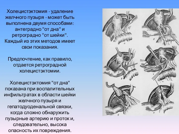 Холецистэктомия - удаление желчного пузыря - может быть выполнена двумя способами: