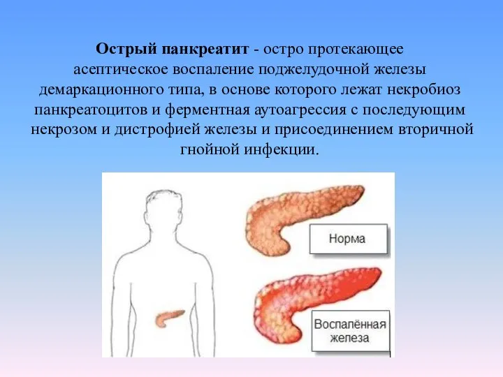 Острый панкреатит - остро протекающее асептическое воспаление поджелудочной железы демаркационного типа,