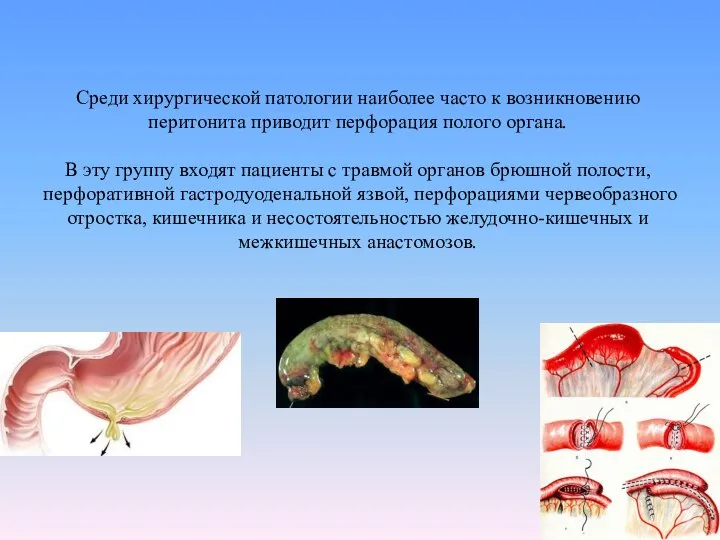 Среди хирургической патологии наиболее часто к возникновению перитонита приводит перфорация полого