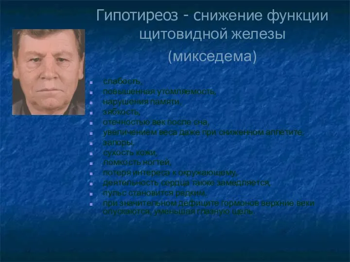 Гипотиреоз - снижение функции щитовидной железы (микседема) слабость, повышенная утомляемость, нарушения