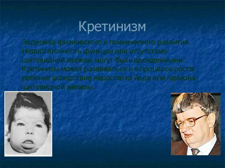 Кретинизм Задержка физического и психического развития. Недостаточность функции или отсутствие щитовидной