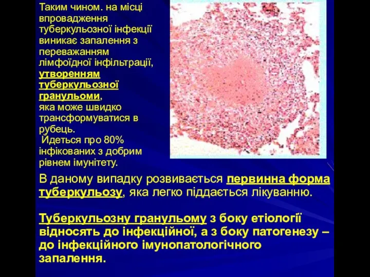 Таким чином. на місці впровадження туберкульозної інфекції виникає запалення з переважанням