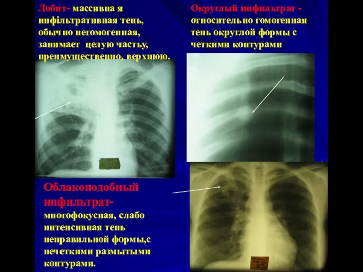 Округлый инфильтрат - относительно гомогенная тень округлой формы с четкими контурами