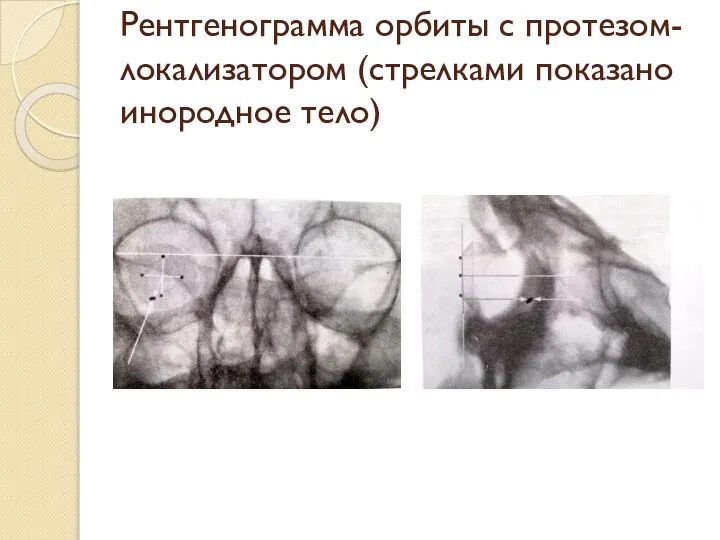 Рентгенограмма орбиты с протезом-локализатором (стрелками показано инородное тело)