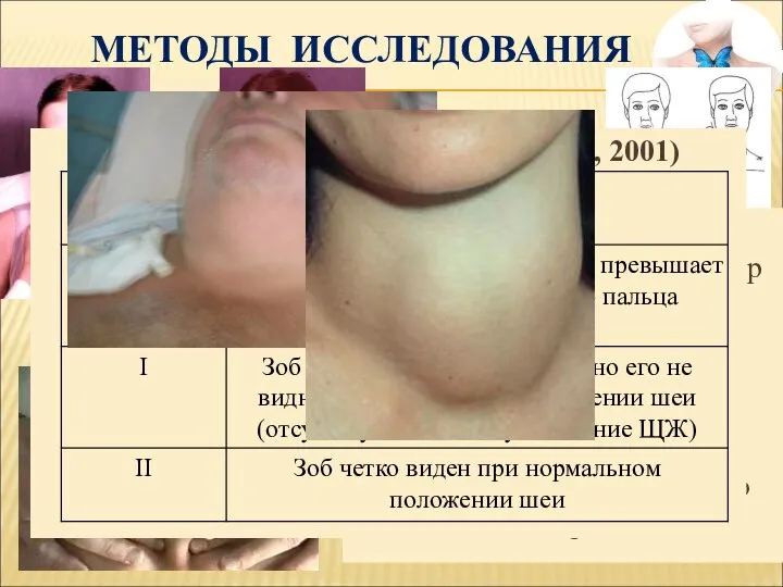 МЕТОДЫ ИССЛЕДОВАНИЯ Пальпация Клинические: Опрос Осмотр Пальпация При пальпации ЩЖ определяют