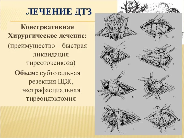 ЛЕЧЕНИЕ ДТЗ Консервативная терапия: тиреостатики (мерказолил, тиразол, пропилтиуроцил); препараты йода, лития;