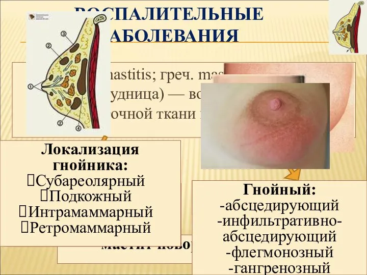 ВОСПАЛИТЕЛЬНЫЕ ЗАБОЛЕВАНИЯ Мастит (mastitis; греч. mastos грудь + -itis; синоним грудница)