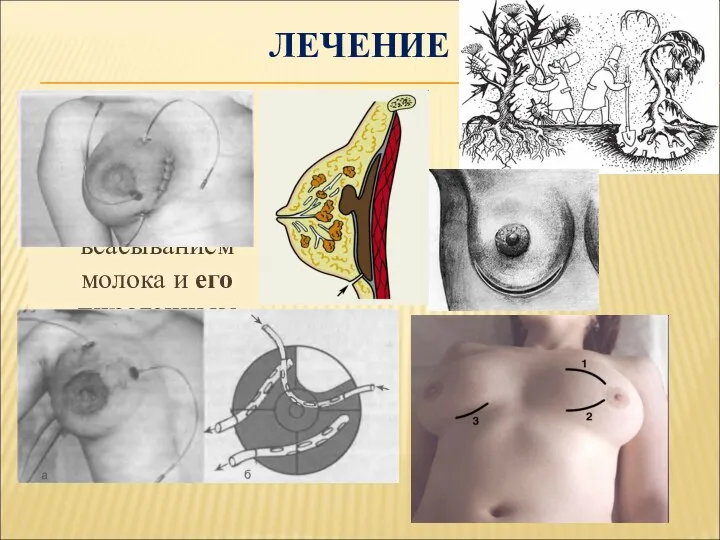 ЛЕЧЕНИЕ Лактостаз повреждение молочных протоков, всасыванием молока и его пирогенным действием
