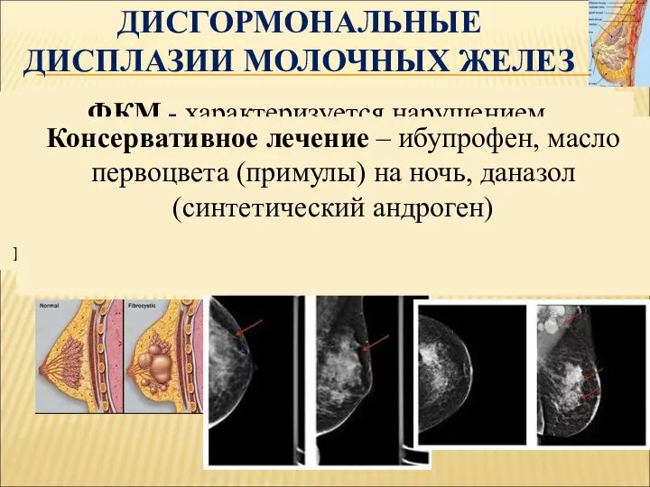 ДИСГОРМОНАЛЬНЫЕ ДИСПЛАЗИИ МОЛОЧНЫХ ЖЕЛЕЗ Фиброзно-кистозная болезнь (мастопатия) – избыточный ответ стромы