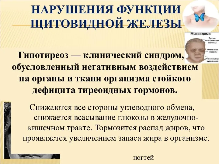 Гипотиреоз — клинический синдром, обусловленный негативным воздействием на органы и ткани