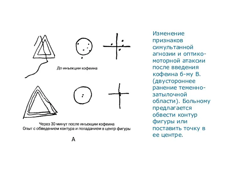 Изменение признаков симультанной агнозии и оптико-моторной атаксии после введения кофеина б-му