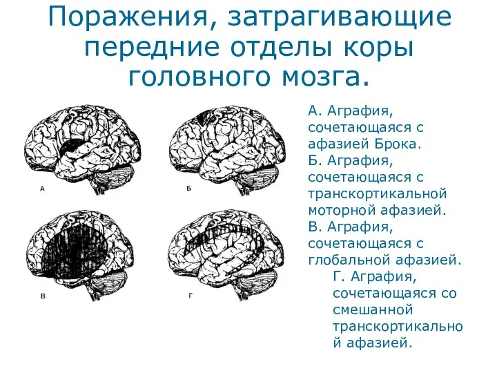 Поражения, затрагивающие передние отделы коры головного мозга. A. Аграфия, сочетающаяся с